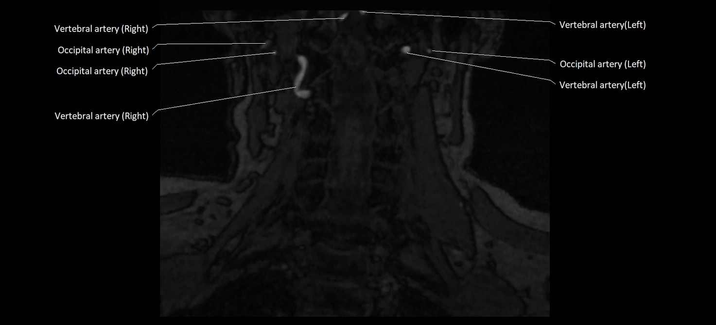 MRA carotid artery anatomy cross sectional 3T coronal image 13.webp